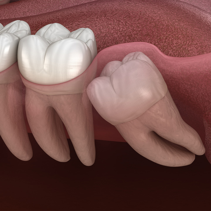 illustration of a wisdom tooth under the gum
