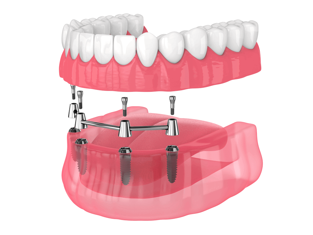 illustration of all-on-4 dental implants
