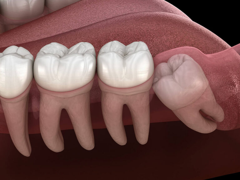 3D rendering of lower jaw molars showing three aligned teeth and a horizontally impacted wisdom tooth pressing against the adjacent molar beneath the gum line.