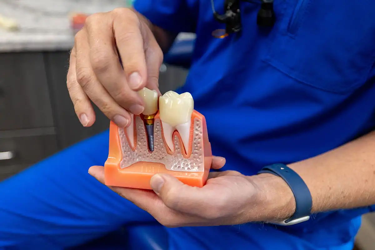 Dental Implants