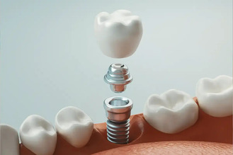 3D rendering of dental implant procedure showing titanium post embedded in jawbone, abutment connector, and ceramic crown positioned above to replace missing tooth.