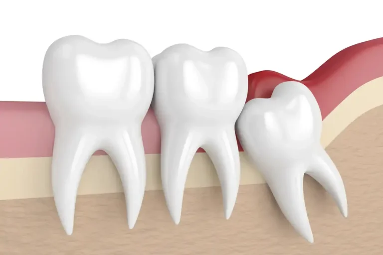 Wisdom Teeth Removal in Selah, WA at Selah Creek Dental