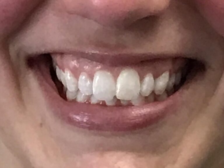 After chipped tooth repair at Selah Creek Dental
