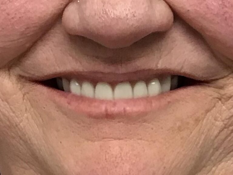 After dentures at Selah Creek Dental