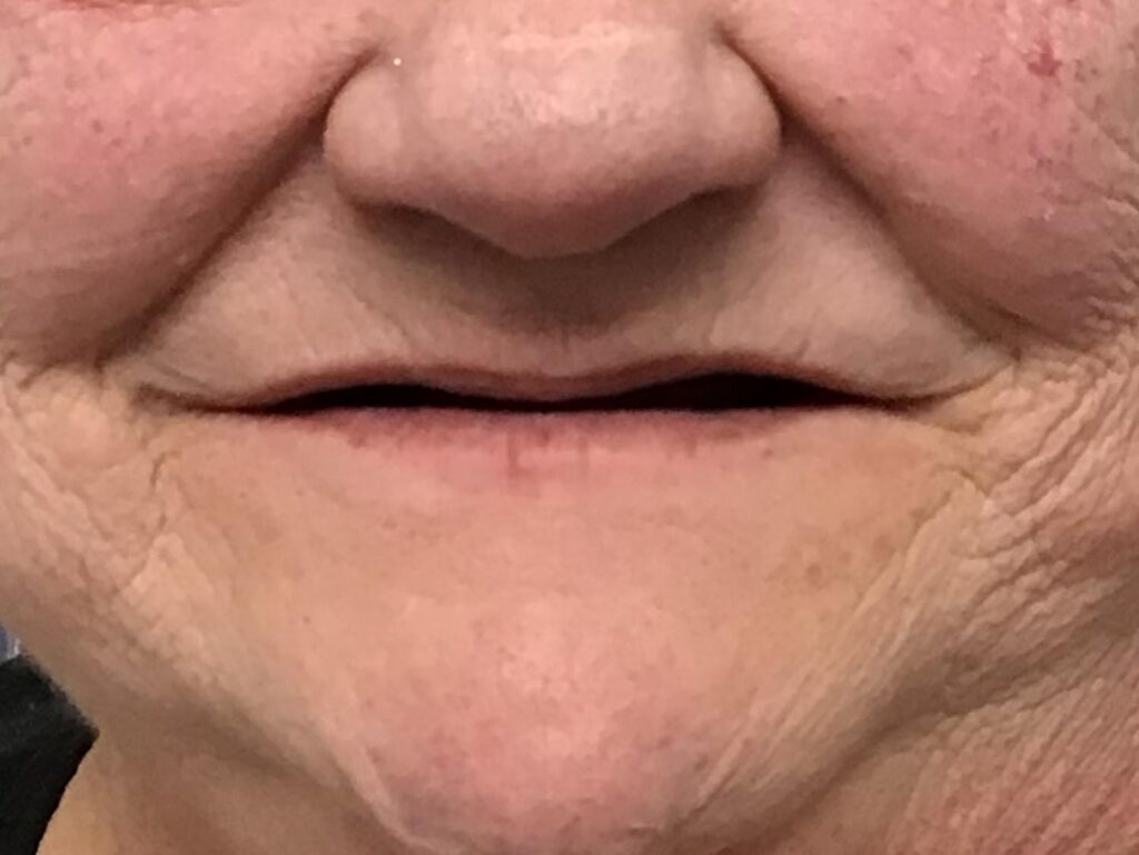 Before dentures at Selah Creek Dental