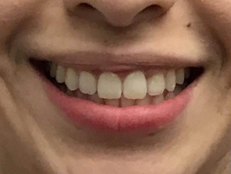 After Dental Crowns at Selah Creek Dental
