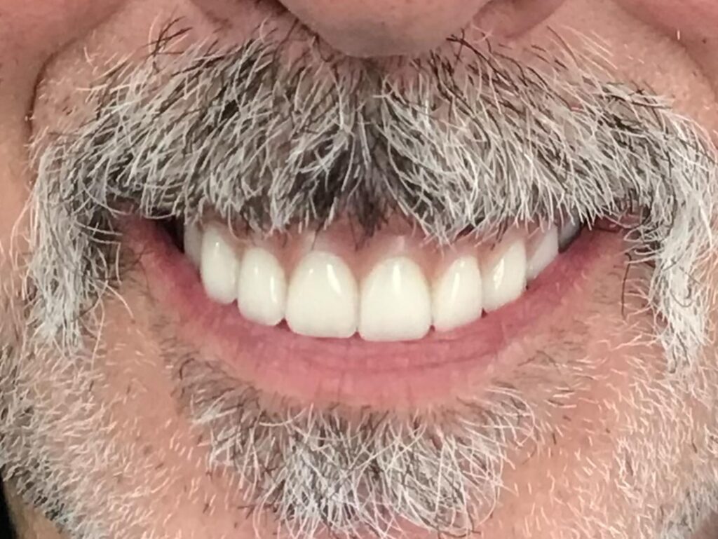 Before dental work at Selah Creek Dental