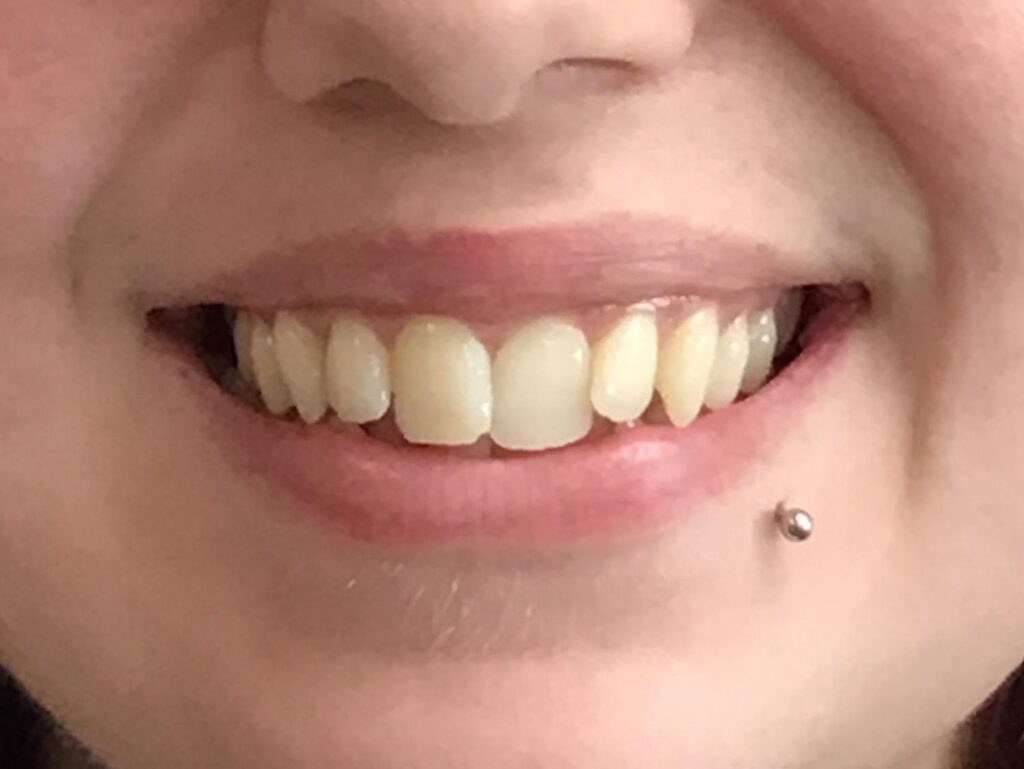 Before clear aligners at Selah creek Dental