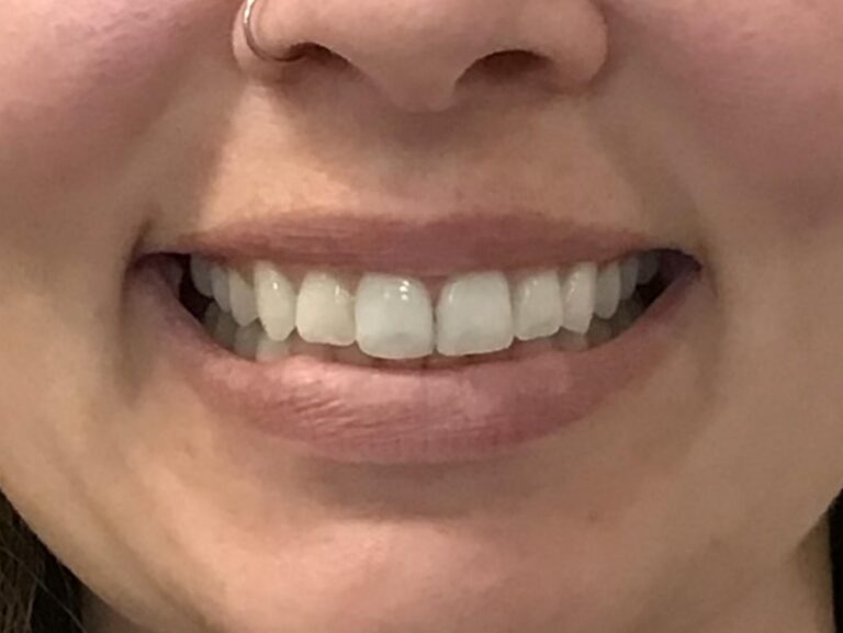 After clear aligners at Selah Creek Dental