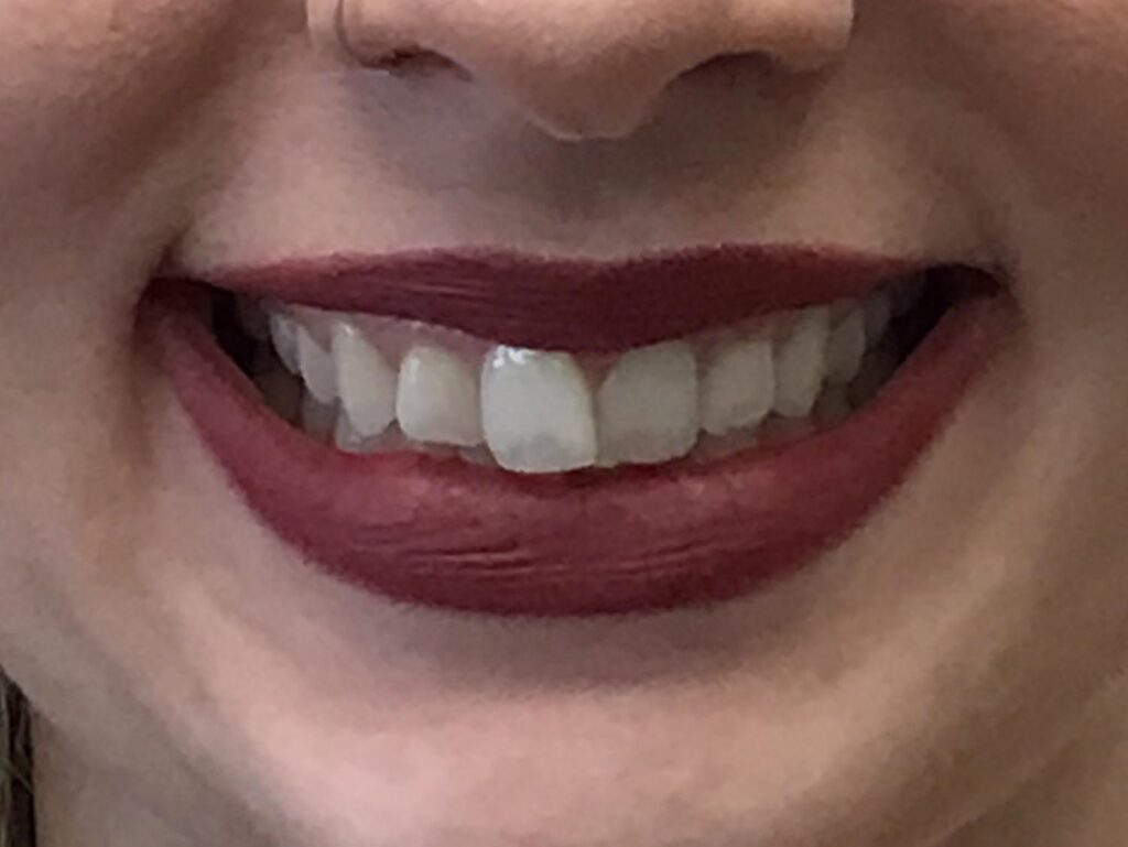 Before clear aligners at Selah Creek Dental