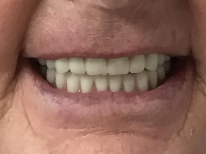 After Dental Implants at Selah Creek Dental