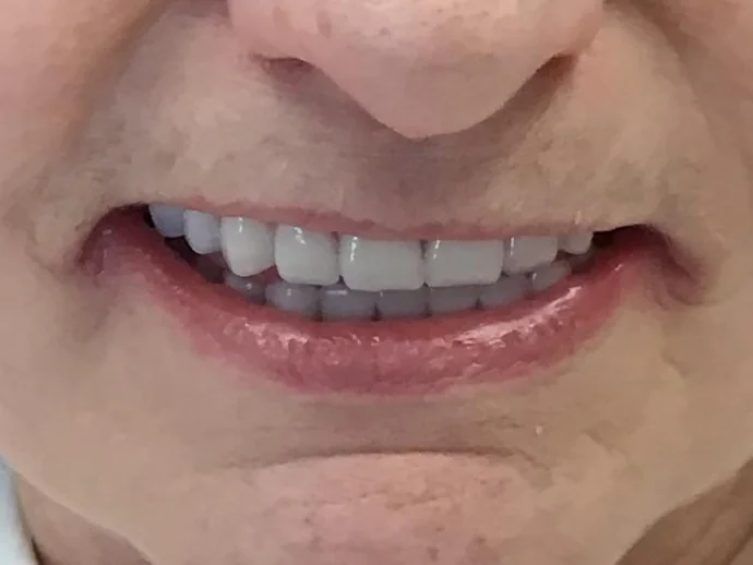 After Dental Implants at Selah Creek Dental
