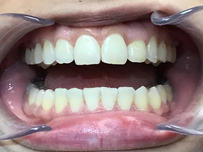 After Invisalign Clear Aligners in Selah, WA