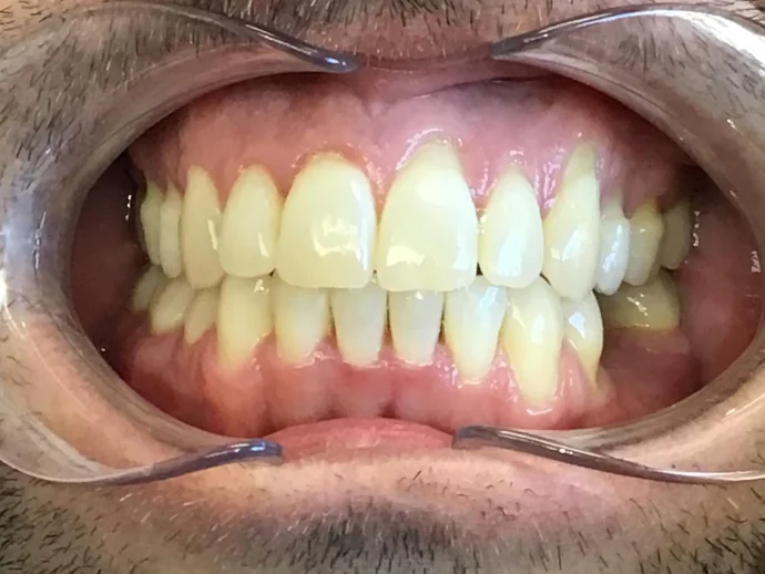 After Invisalign Clear Aligners in Selah, WA