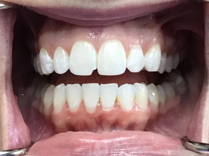 After Invisalign Clear Aligners in Selah, WA