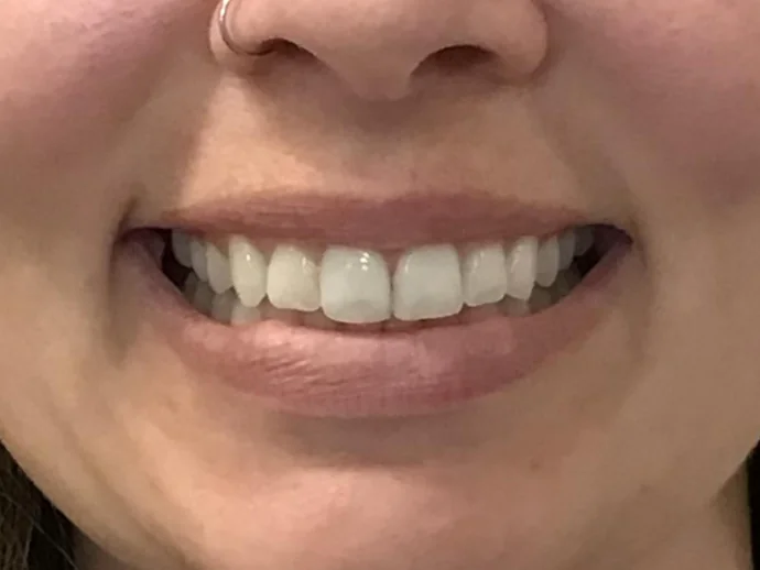 After Invisalign Clear Aligners in Selah, WA