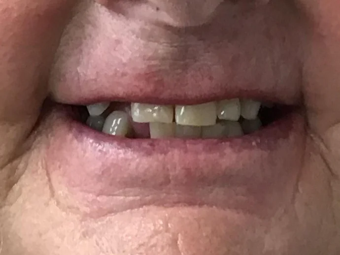 Before Dental Implants at Selah Creek Dental