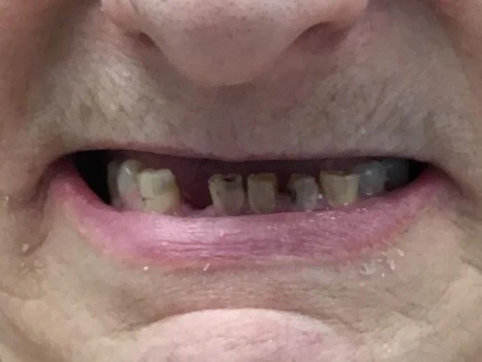 Before Dental Implants at Selah Creek Dental