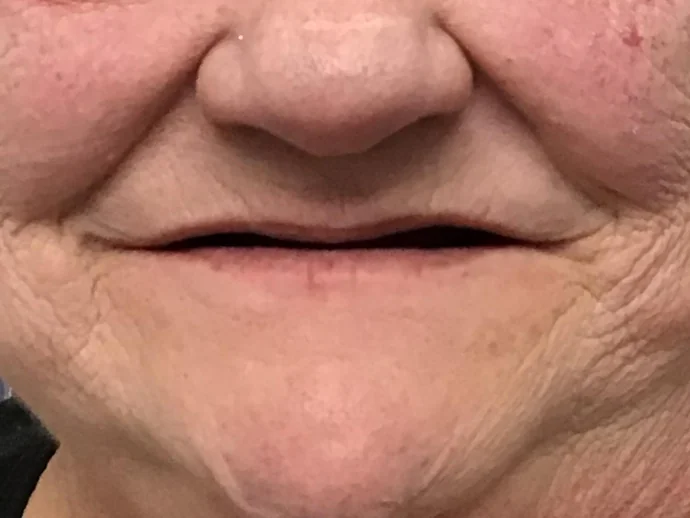 Before Dental Implants at Selah Creek Dental