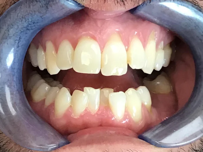 Before Invisalign Clear Aligners in Selah, WA