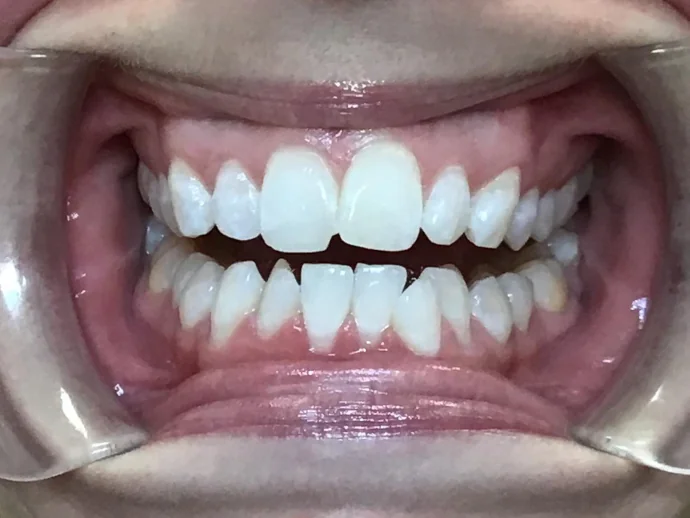 Before Invisalign Clear Aligners in Selah, WA