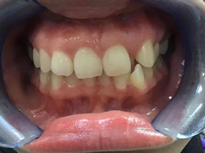 Before Invisalign Clear Aligners in Selah, WA